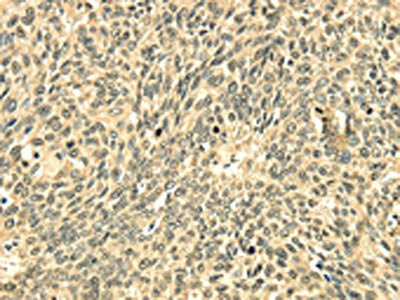 The image on the left is immunohistochemistry of paraffin-embedded Human lung cancer tissue using CSB-PA160915(ECE2 Antibody) at dilution 1/20, on the right is treated with fusion protein. (Original magnification: ×200)