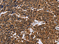 The image on the left is immunohistochemistry of paraffin-embedded Human cervical cancer tissue using CSB-PA161267(EDN2 Antibody) at dilution 1/30, on the right is treated with fusion protein. (Original magnification: ×200)