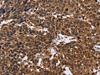 The image on the left is immunohistochemistry of paraffin-embedded Human cervical cancer tissue using CSB-PA161267(EDN2 Antibody) at dilution 1/30, on the right is treated with fusion protein. (Original magnification: ×200)