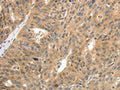 The image on the left is immunohistochemistry of paraffin-embedded Human ovarian cancer tissue using CSB-PA161346(CNNM3 Antibody) at dilution 1/25, on the right is treated with fusion protein. (Original magnification: ×200)