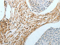 The image on the left is immunohistochemistry of paraffin-embedded Human cervical cancer tissue using CSB-PA161781(CRMP1 Antibody) at dilution 1/20, on the right is treated with fusion protein. (Original magnification: ×200)