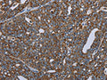 The image on the left is immunohistochemistry of paraffin-embedded Human ovarian cancer tissue using CSB-PA161916(NDUFA13 Antibody) at dilution 1/50, on the right is treated with fusion protein. (Original magnification: ×200)