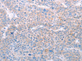 The image on the left is immunohistochemistry of paraffin-embedded Human liver cancer tissue using CSB-PA161929(SPATA6 Antibody) at dilution 1/50, on the right is treated with fusion protein. (Original magnification: ×200)