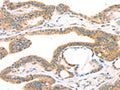 The image on the left is immunohistochemistry of paraffin-embedded Human thyroid cancer tissue using CSB-PA161937(TPH2 Antibody) at dilution 1/25, on the right is treated with synthetic peptide. (Original magnification: ×200)