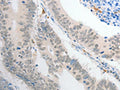 The image on the left is immunohistochemistry of paraffin-embedded Human colon cancer tissue using CSB-PA162244(POU2F1 Antibody) at dilution 1/30, on the right is treated with fusion protein. (Original magnification: ×200)