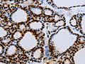 The image on the left is immunohistochemistry of paraffin-embedded Human thyroid cancer tissue using CSB-PA162597(EGFR Antibody) at dilution 1/15, on the right is treated with synthetic peptide. (Original magnification: ×200)