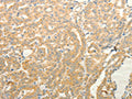 The image on the left is immunohistochemistry of paraffin-embedded Human thyroid cancer tissue using CSB-PA162676(TPH1 Antibody) at dilution 1/20, on the right is treated with fusion protein. (Original magnification: ×200)