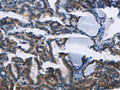 The image on the left is immunohistochemistry of paraffin-embedded Human thyroid cancer tissue using CSB-PA162717(TWF2 Antibody) at dilution 1/30, on the right is treated with fusion protein. (Original magnification: ×200)