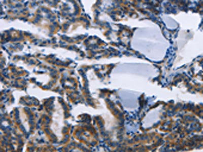 The image on the left is immunohistochemistry of paraffin-embedded Human thyroid cancer tissue using CSB-PA162717(TWF2 Antibody) at dilution 1/30, on the right is treated with fusion protein. (Original magnification: ×200)