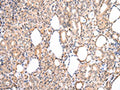 The image on the left is immunohistochemistry of paraffin-embedded Human thyroid cancer tissue using CSB-PA162953(CDK8 Antibody) at dilution 1/20, on the right is treated with synthetic peptide. (Original magnification: ×200)