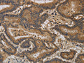 The image on the left is immunohistochemistry of paraffin-embedded Human thyroid cancer tissue using CSB-PA163077(CCL26 Antibody) at dilution 1/20, on the right is treated with synthetic peptide. (Original magnification: ×200)