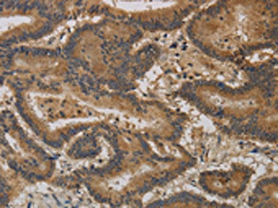 The image on the left is immunohistochemistry of paraffin-embedded Human thyroid cancer tissue using CSB-PA163077(CCL26 Antibody) at dilution 1/20, on the right is treated with synthetic peptide. (Original magnification: ×200)