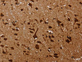 The image on the left is immunohistochemistry of paraffin-embedded Human brain tissue using CSB-PA163096(KARS Antibody) at dilution 1/60, on the right is treated with fusion protein. (Original magnification: ×200)