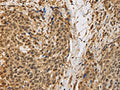 The image on the left is immunohistochemistry of paraffin-embedded Human cervical cancer tissue using CSB-PA163656(BRAF Antibody) at dilution 1/30, on the right is treated with synthetic peptide. (Original magnification: ×200)