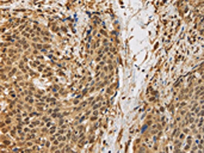 The image on the left is immunohistochemistry of paraffin-embedded Human cervical cancer tissue using CSB-PA163656(BRAF Antibody) at dilution 1/30, on the right is treated with synthetic peptide. (Original magnification: ×200)