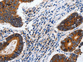 The image on the left is immunohistochemistry of paraffin-embedded Human colon cancer tissue using CSB-PA164023(CDH1 Antibody) at dilution 1/100, on the right is treated with synthetic peptide. (Original magnification: x200)