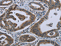 The image on the left is immunohistochemistry of paraffin-embedded Human gastic cancer tissue using CSB-PA164096(GNG2 Antibody) at dilution 1/50, on the right is treated with fusion protein. (Original magnification: ×200)