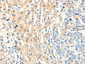 The image on the left is immunohistochemistry of paraffin-embedded Human breast cancer tissue using CSB-PA164310(PAK7 Antibody) at dilution 1/20, on the right is treated with fusion protein. (Original magnification: ×200)