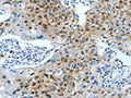 The image on the left is immunohistochemistry of paraffin-embedded Human lung cancer tissue using CSB-PA164448(JUN Antibody) at dilution 1/30, on the right is treated with fusion protein. (Original magnification: ×200)
