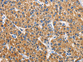 The image on the left is immunohistochemistry of paraffin-embedded Human liver cancer tissue using CSB-PA165028(APLNR Antibody) at dilution 1/40, on the right is treated with fusion protein. (Original magnification: ×200)