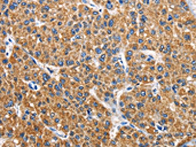 The image on the left is immunohistochemistry of paraffin-embedded Human liver cancer tissue using CSB-PA165028(APLNR Antibody) at dilution 1/40, on the right is treated with fusion protein. (Original magnification: ×200)