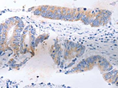 The image on the left is immunohistochemistry of paraffin-embedded Human colon cancer tissue using CSB-PA165399(SERP1 Antibody) at dilution 1/30, on the right is treated with fusion protein. (Original magnification: ×200)
