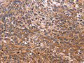 The image on the left is immunohistochemistry of paraffin-embedded Human cervical cancer tissue using CSB-PA165659(GCG Antibody) at dilution 1/20, on the right is treated with synthetic peptide. (Original magnification: ×200)