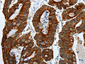 The image on the left is immunohistochemistry of paraffin-embedded Human colon cancer tissue using CSB-PA165755(KRT19 Antibody) at dilution 1/55, on the right is treated with fusion protein. (Original magnification: ×200)