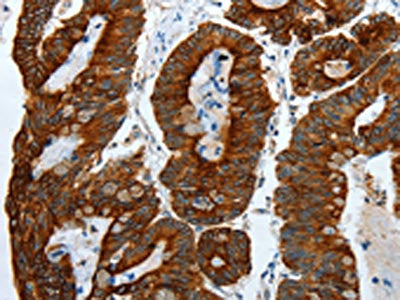 The image on the left is immunohistochemistry of paraffin-embedded Human colon cancer tissue using CSB-PA165755(KRT19 Antibody) at dilution 1/55, on the right is treated with fusion protein. (Original magnification: ×200)