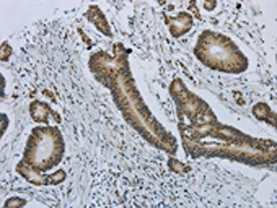 The image on the left is immunohistochemistry of paraffin-embedded Human colorectal cancer tissue using CSB-PA166201(MMP24 Antibody) at dilution 1/25, on the right is treated with synthetic peptide. (Original magnification: ×200)