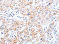 The image on the left is immunohistochemistry of paraffin-embedded Human lung cancer tissue using CSB-PA166219(SCARB1 Antibody) at dilution 1/30, on the right is treated with synthetic peptide. (Original magnification: ×200)