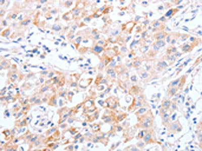 The image on the left is immunohistochemistry of paraffin-embedded Human lung cancer tissue using CSB-PA166219(SCARB1 Antibody) at dilution 1/30, on the right is treated with synthetic peptide. (Original magnification: ×200)