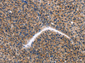 The image on the left is immunohistochemistry of paraffin-embedded Human liver cancer tissue using CSB-PA166299(KLF15 Antibody) at dilution 1/30, on the right is treated with fusion protein. (Original magnification: ×200)