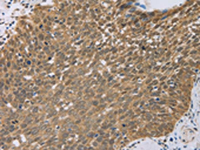 The image on the left is immunohistochemistry of paraffin-embedded Human cervical cancer tissue using CSB-PA166329(PCP4 Antibody) at dilution 1/50, on the right is treated with fusion protein. (Original magnification: ×200)