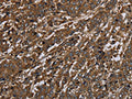 The image on the left is immunohistochemistry of paraffin-embedded Human liver cancer tissue using CSB-PA166476(HPGD Antibody) at dilution 1/30, on the right is treated with fusion protein. (Original magnification: ×200)