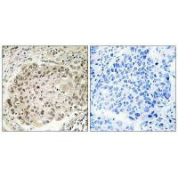 Immunohistochemistry analysis of paraffin-embedded human lung carcinoma tissue using USP36 antibody.