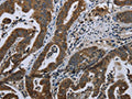 The image on the left is immunohistochemistry of paraffin-embedded Human gastic cancer tissue using CSB-PA167353(BRINP1 Antibody) at dilution 1/20, on the right is treated with fusion protein. (Original magnification: ×200)