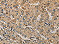 The image on the left is immunohistochemistry of paraffin-embedded Human liver cancer tissue using CSB-PA167583(MIP Antibody) at dilution 1/60, on the right is treated with fusion protein. (Original magnification: ×200)