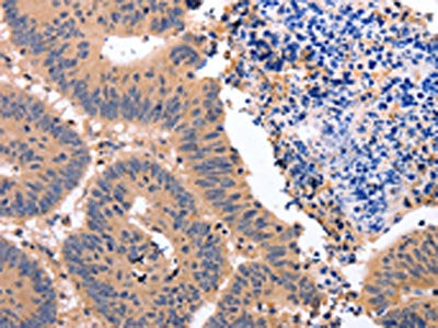 The image on the left is immunohistochemistry of paraffin-embedded Human colon cancer tissue using CSB-PA167985(NR3C1 Antibody) at dilution 1/50, on the right is treated with synthetic peptide. (Original magnification: ×200)