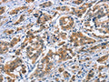 The image on the left is immunohistochemistry of paraffin-embedded Human breast cancer tissue using CSB-PA168224(CRABP2 Antibody) at dilution 1/20, on the right is treated with fusion protein. (Original magnification: ×200)