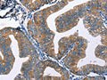 The image on the left is immunohistochemistry of paraffin-embedded Human cervical cancer tissue using CSB-PA168757(EDN2 Antibody) at dilution 1/50, on the right is treated with fusion protein. (Original magnification: ×200)