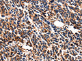 The image on the left is immunohistochemistry of paraffin-embedded Human breast cancer tissue using CSB-PA168758(LGALS3 Antibody) at dilution 1/5, on the right is treated with fusion protein. (Original magnification: ×200)