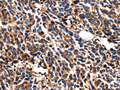 The image on the left is immunohistochemistry of paraffin-embedded Human breast cancer tissue using CSB-PA168758(LGALS3 Antibody) at dilution 1/5, on the right is treated with fusion protein. (Original magnification: ×200)