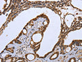 The image on the left is immunohistochemistry of paraffin-embedded Human thyroid cancer tissue using CSB-PA168936(CXCR3  Antibody) at dilution 1/20, on the right is treated with synthetic peptide. (Original magnification: ×200)