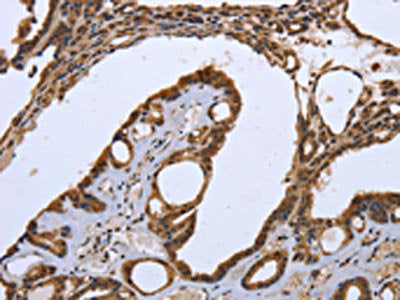 The image on the left is immunohistochemistry of paraffin-embedded Human thyroid cancer tissue using CSB-PA168936(CXCR3  Antibody) at dilution 1/20, on the right is treated with synthetic peptide. (Original magnification: ×200)
