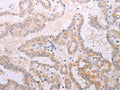 The image on the left is immunohistochemistry of paraffin-embedded Human thyroid cancer tissue using CSB-PA169016(TPO Antibody) at dilution 1/50, on the right is treated with fusion protein. (Original magnification: ×200)