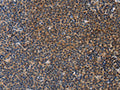 The image on the left is immunohistochemistry of paraffin-embedded Human lymphoma tissue using CSB-PA169208(STRADB Antibody) at dilution 1/20, on the right is treated with fusion protein. (Original magnification: ×200)