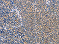The image on the left is immunohistochemistry of paraffin-embedded Human Lymphoma tissue using CSB-PA169235(CCL16  Antibody) at dilution 1/50, on the right is treated with synthetic peptide. (Original magnification: ×200)