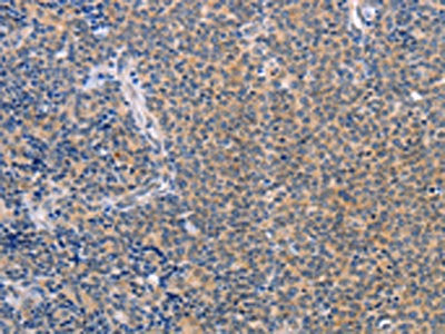 The image on the left is immunohistochemistry of paraffin-embedded Human Lymphoma tissue using CSB-PA169235(CCL16  Antibody) at dilution 1/50, on the right is treated with synthetic peptide. (Original magnification: ×200)