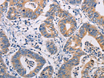 The image on the left is immunohistochemistry of paraffin-embedded Human gastic cancer tissue using CSB-PA169274(AGPS Antibody) at dilution 1/25, on the right is treated with fusion protein. (Original magnification: ×200)